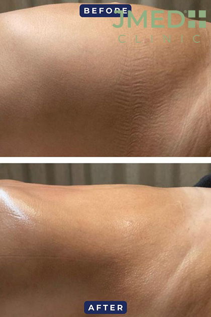 Say Goodbye to Stretch Marks: Effective Removal Techniques