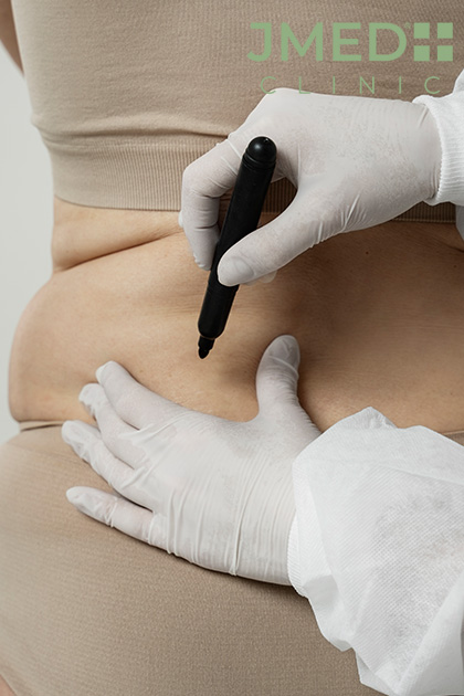 Stretch Mark Removal Explained: Causes, Treatments, and Results