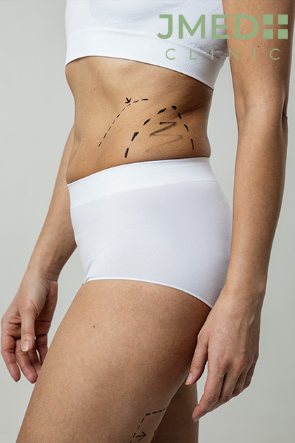 What Causes Stretch Marks and How to Get Rid of Them
