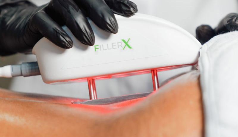 JMED FILLER X DEVICE