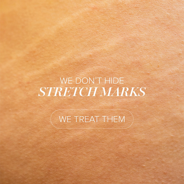 Arm Stretch Marks Solution