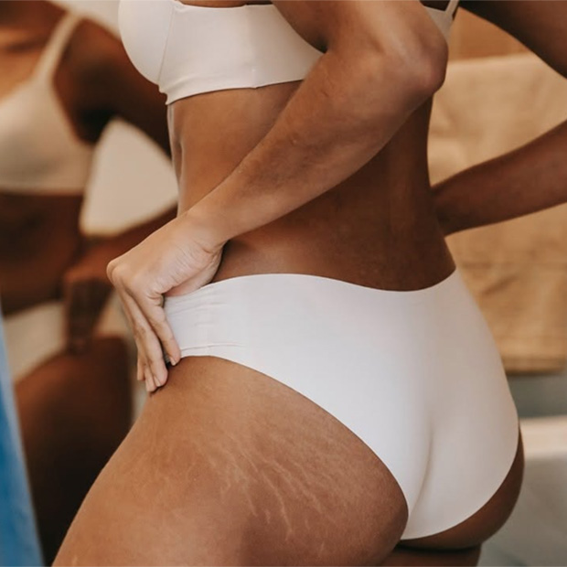 Lower Back Stretch Marks