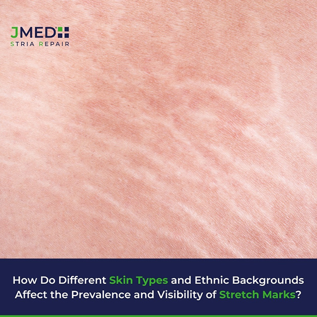 Thigh Stretch Mark Removal