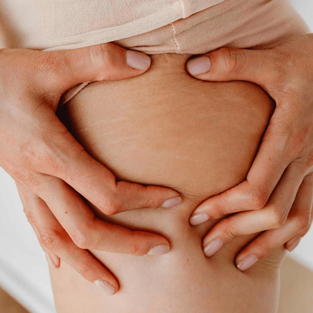 Deep Stretch Mark Repair