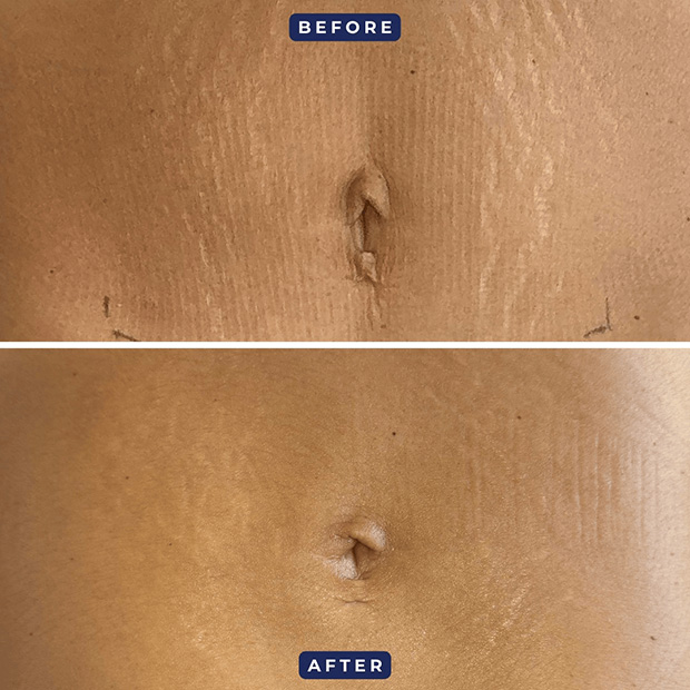No-Ink Stretch Mark Treatment