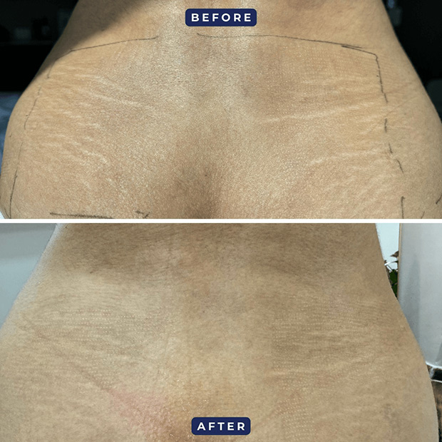 Ink-Free Skin Restoration