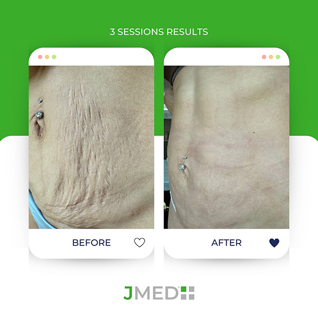 Stretch Mark Microneedling