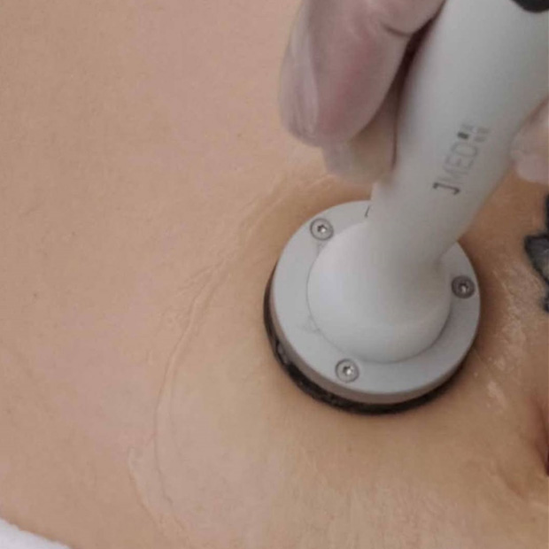 Microneedling For Stretch Marks