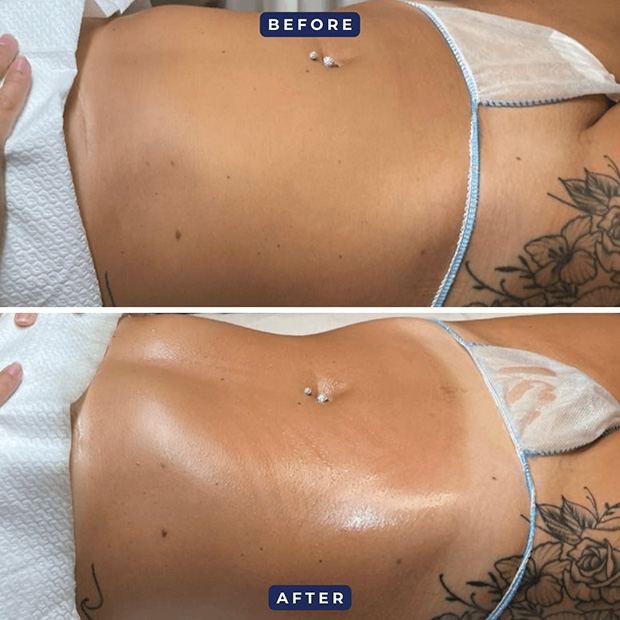 Plant-Based Stretch Mark Treatment