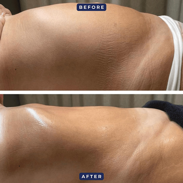 Natural Stretch Mark Removal