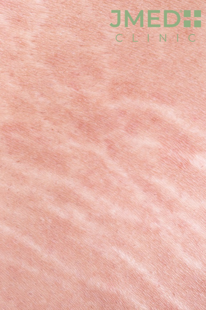 Natural ways to get rid of stretch marks