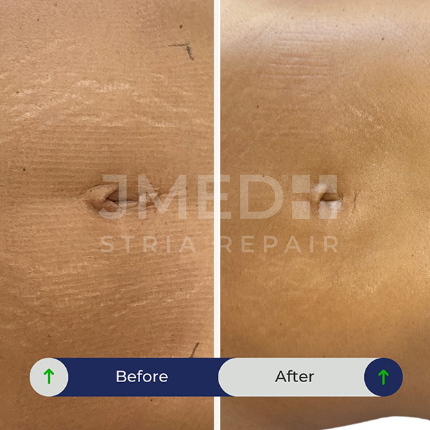 How To Fade Old Stretch Marks