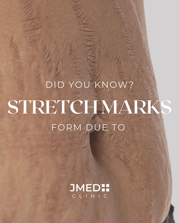 Organic Stretch Mark Oil