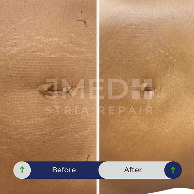 Reduce Red Skin Lines