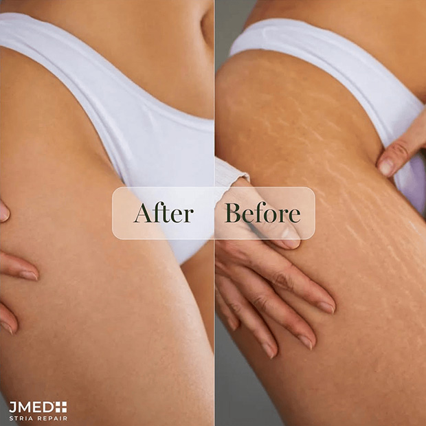Red Stretch Mark Treatment