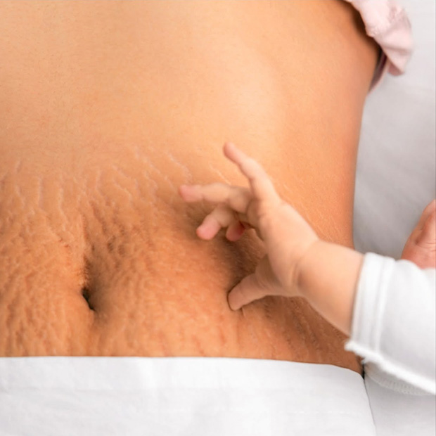 Firm Saggy Skin With Stretch Marks