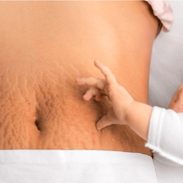 Stretch Marks From Loose Skin
