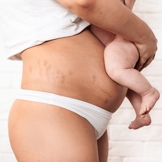 Stretch Mark Treatment For Pregnancy