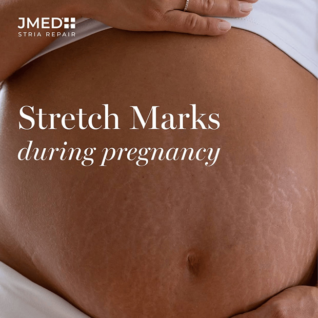 After Pregnancy Stretch Mark Removal