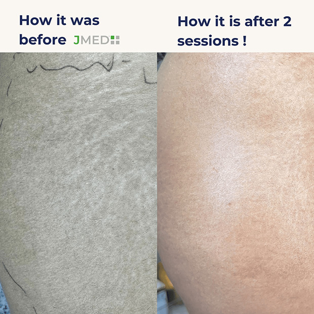 Stretch Marks Removal For Women