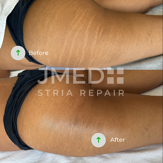 Women Stretch Marks Removal