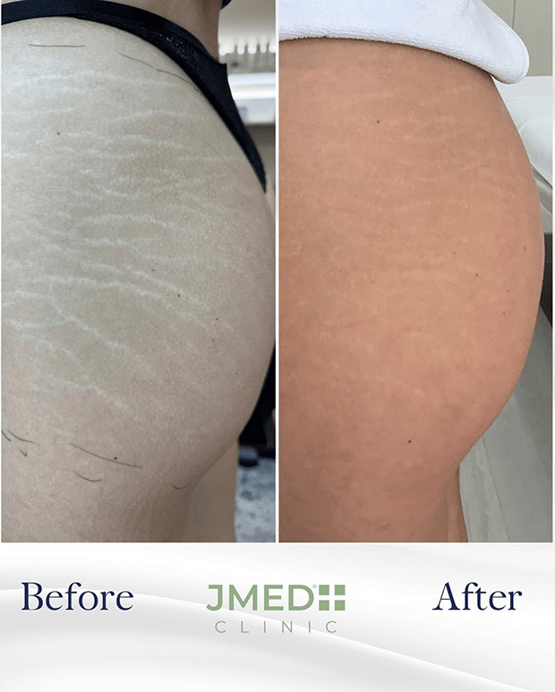 Stretch Mark Removal For Women