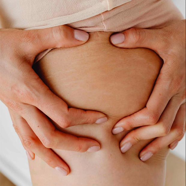 Stretch Marks On Thighs During Puberty