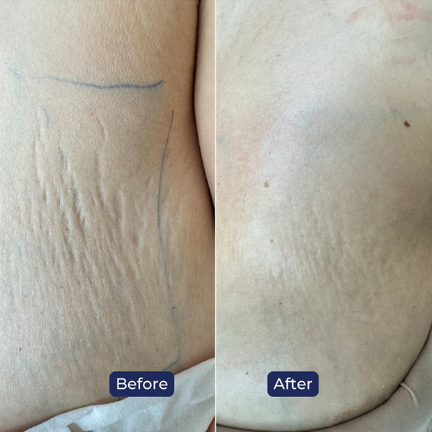 Teen Stretch Mark Treatment
