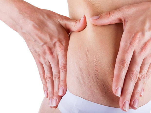 Stomach Stretch Mark Treatment
