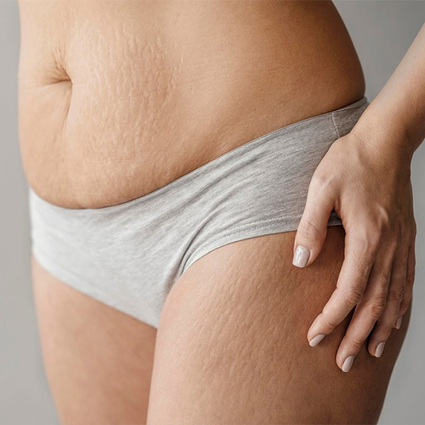 Stomach Stretch Mark Removal