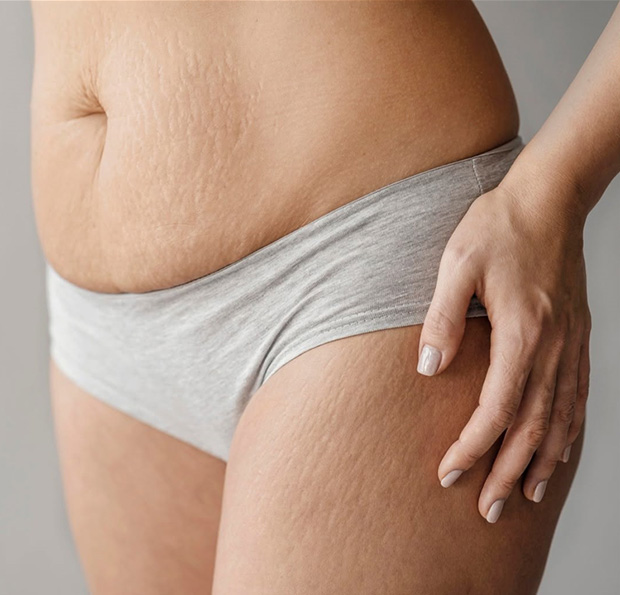Tummy Stretch Mark Repair
