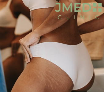 What Causes Stretch Marks During Puberty