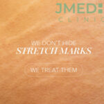 What Is the Best Treatment to Remove Stretch Marks?
