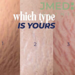 What are stretch marks and why do they appear?