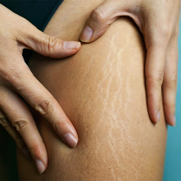 White Scar-Like Stretch Marks