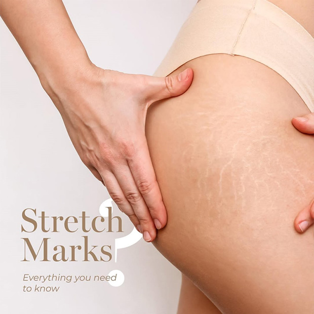 White Stretch Mark Removal