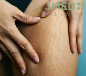 Why Do I Get Stretch Marks Even Though I’m Thin?