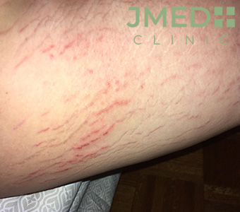Why do I have so Many Stretch Marks On My Thighs? Why do I have so Many Stretch Marks On My Thighs?