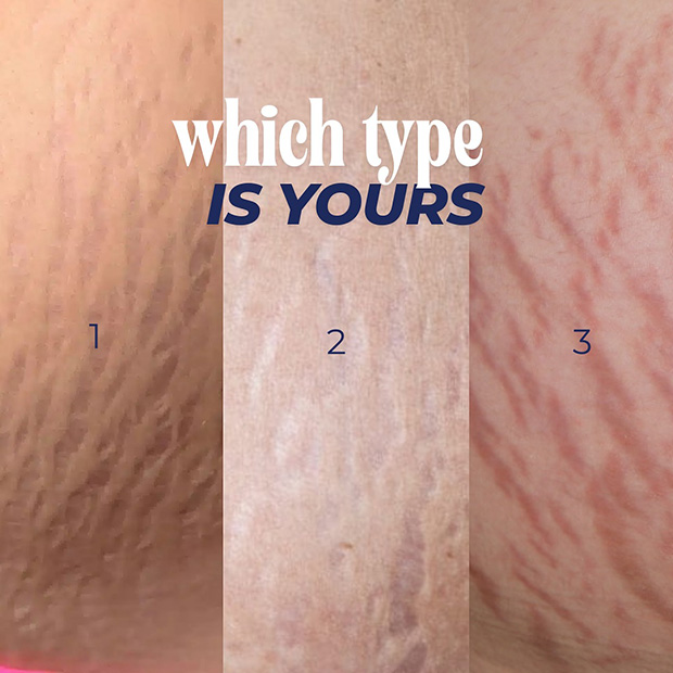 Stretch Mark Removal Without Laser