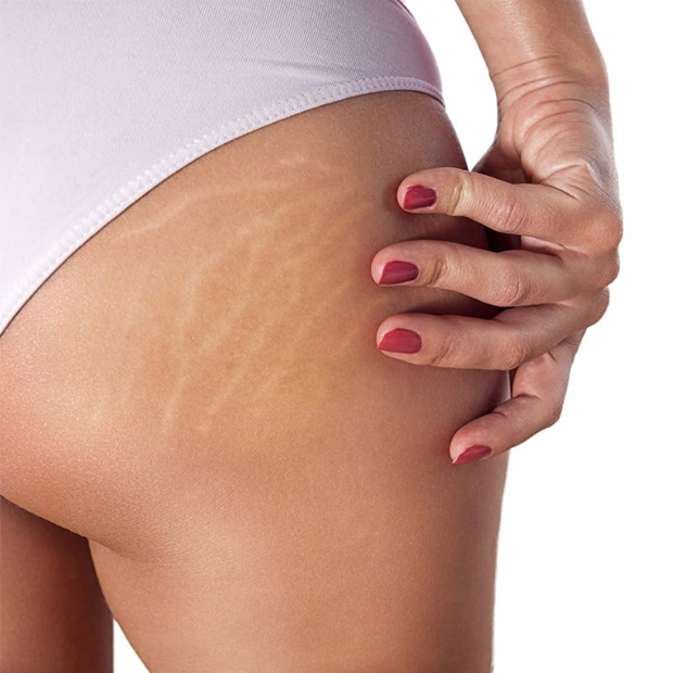 Without Laser Stretch Mark Removal