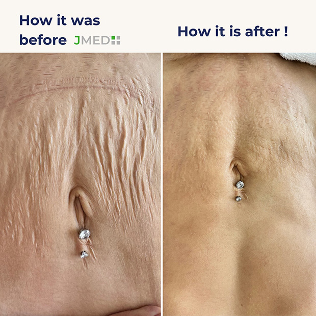 Without Laser Stretch Mark Removal Treatment