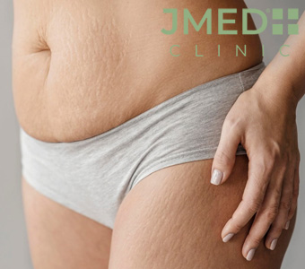 Can Working Out or Gaining Muscle Cause Stretch Marks?