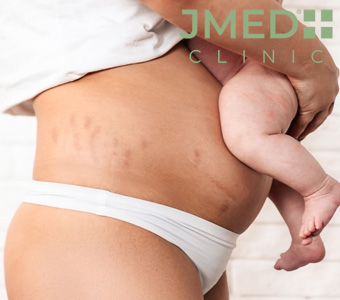 Do Pregnancy Stretch Marks Ever Disappear?