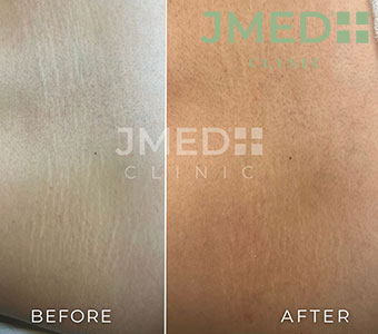 Is Laser Treatment Safe for Stretch Marks?