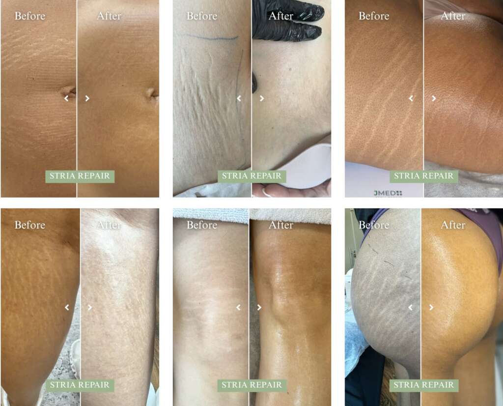 JMED-Stria-Repair-Method™-Before-After-Images