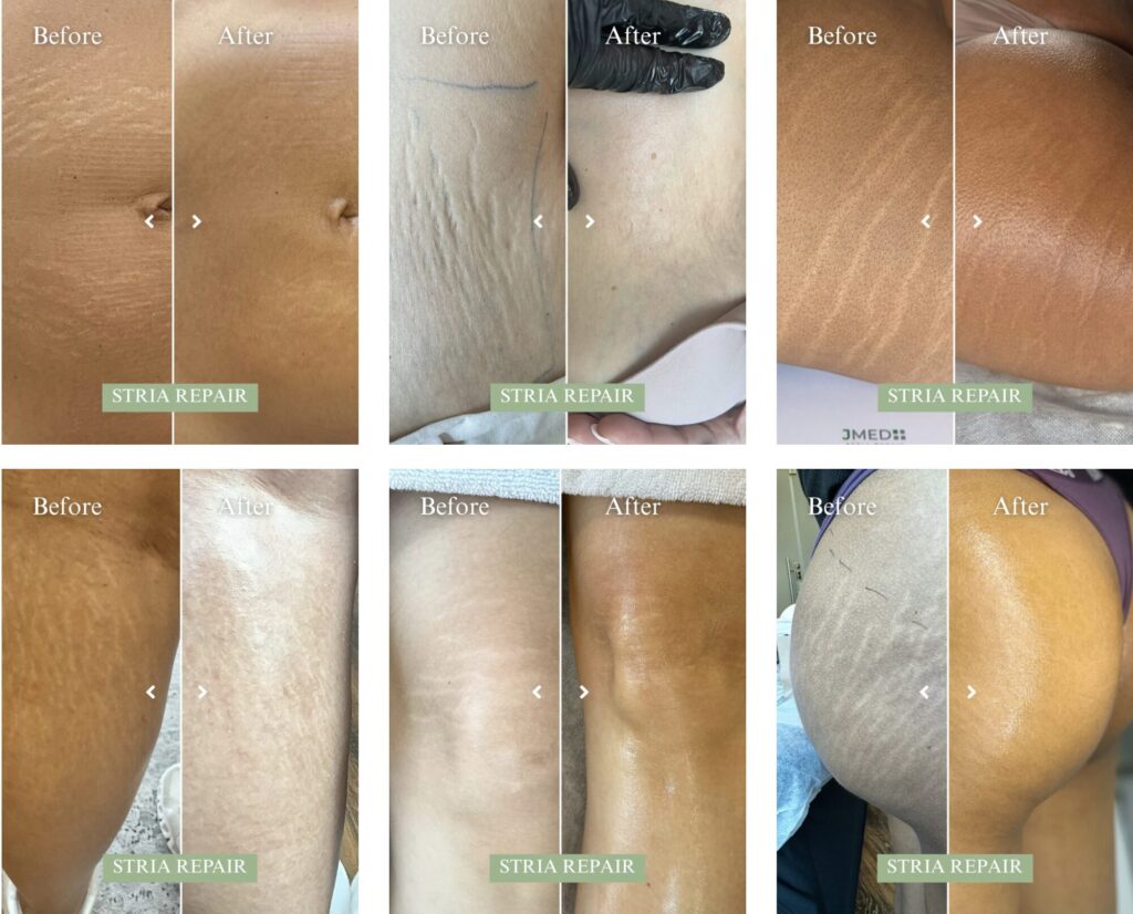 JMED-Stria-Repair-Method™-Before-After-Images