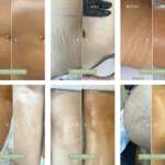 Laser vs JMED Stria Repair Method™: Which Stretch Mark Treatment Works Better?