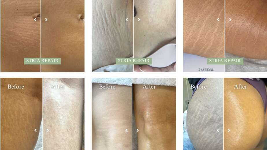 Laser vs JMED Stria Repair Method™: Which Stretch Mark Treatment Works Better?