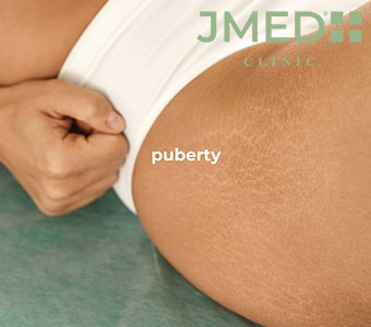 What Is Inkless Stretch Mark Camouflage?