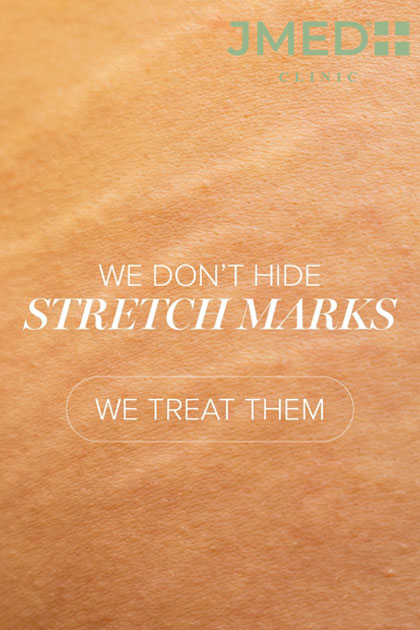 stretch marks removal cost in dubai